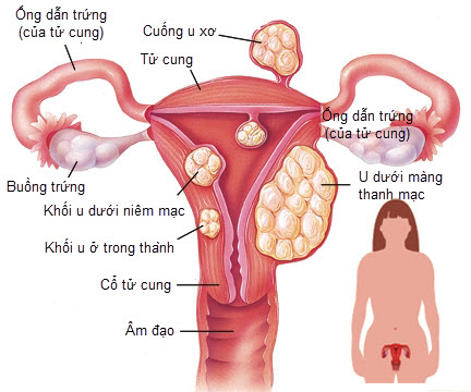 Chị em nào dễ mắc bệnh ung thư cổ tử cung ?